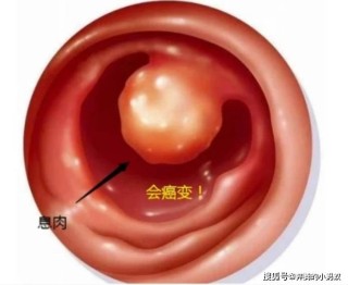 微博:今晚澳门开准确生肖12月4日-什么是宫颈息肉