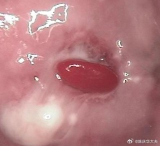 微博:今晚澳门开准确生肖12月4日-什么是宫颈息肉