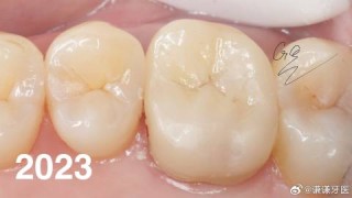 微博:澳门2024正版资料王中王-牙齿有裂纹是什么原因