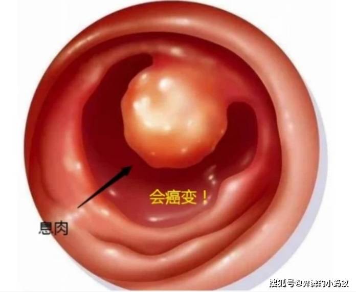微博:今晚澳门开准确生肖12月4日-什么是宫颈息肉  第2张